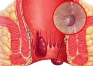 What does hemorrhoid look like