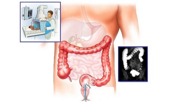 Contrast-enhanced colon radiography for the diagnosis of hemorrhoids
